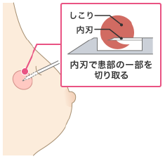 病理検査　針生検のイメージイラスト